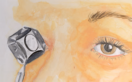 Drawing of a Gonioscopy